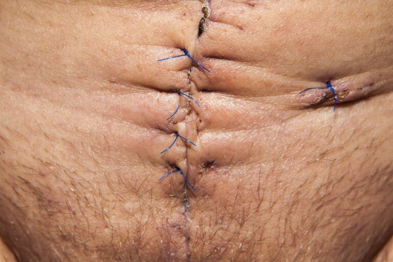 op, operation, abdomen surgery-103061.jpg